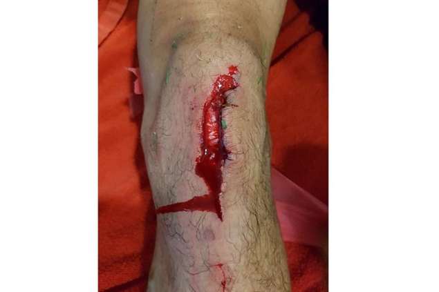 Entrada de Marega deixou joelho de Fejsa assim