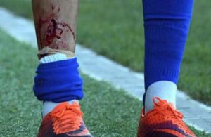 Assim ficou a tíbia de um jogador espanhol