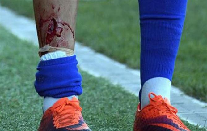 Assim ficou a tíbia de um jogador espanhol